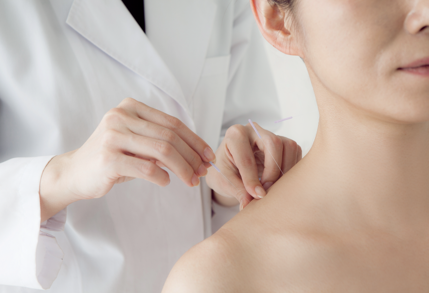 How-can-an-Acupuncturist-help